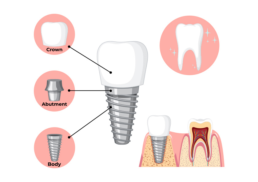 Extractions-Implants