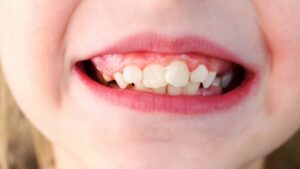 clear aligners in Olathe